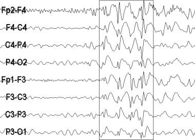 An electroencephalogram (EEG) recording from a pat
