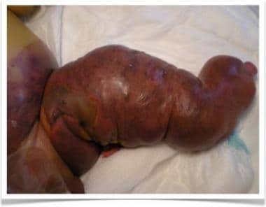 Newborn boy with Parks-Weber syndrome. Note diffus