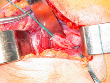 The capsule is exposed by splitting the deltoid in