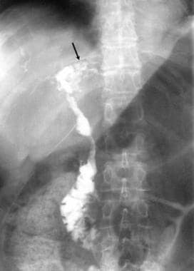 This T-tube cholangiogram shows an irregularity of