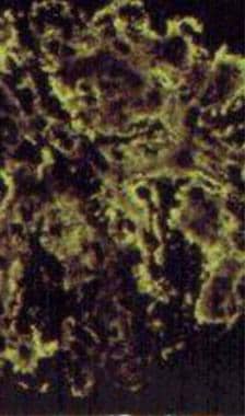 Light chain–associated renal disorders. Immunofluo