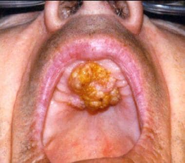 Squamous cell carcinoma of the hard palate. 