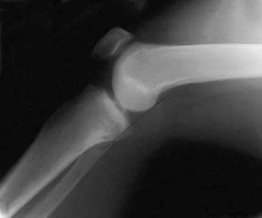 A lateral radiograph of a knee with a posterior cr