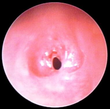 An endoscopic subglottic view of a 4-month-old wit