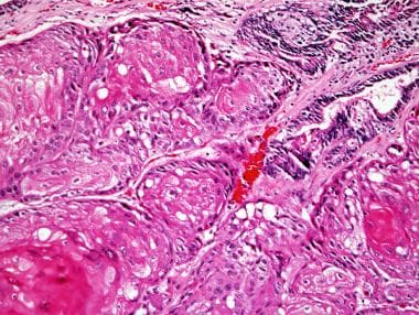 Squamous cell carcinoma of the prostate, with kera