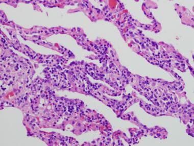 A case of hypersensitivity pneumonitis in a 48-yea