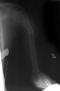 Fracture of an osteoporotic bone in a patient with