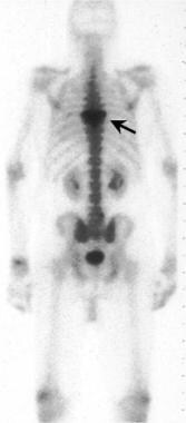 Posterior view from a radionuclide bone scan. A fo