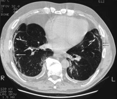 Asbestosis. High-resolution CT scan more inferiorl