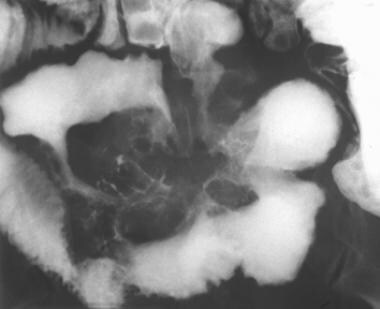 Crohn disease. Small-bowel follow-through study de