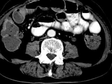 Left ureterectasis secondary to a distal ureteral 