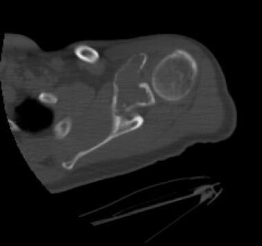 Axial computed tomography scan of the glenoid (sam