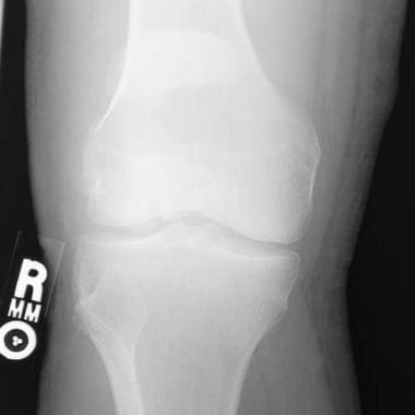 Radiograph of a displaced transverse fracture of t