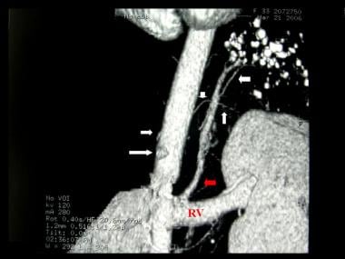 Contrast enhanced computed tomography angiogram in