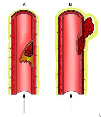 Arterial dissection. A, Tear and elevation of the 