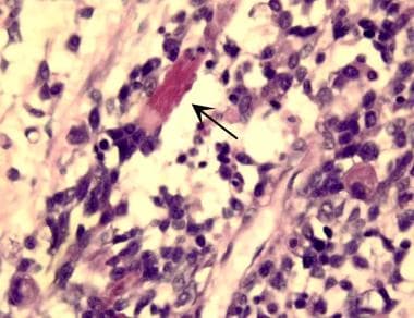 Embryonal rhabdomyosarcoma is evidenced by a varia