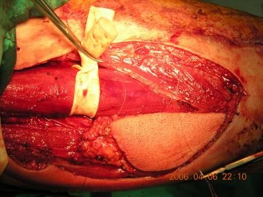 Skin paddle over the gracilis muscle is harvested 