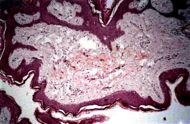 A hyperplastic epidermis showing papillomatosis, h