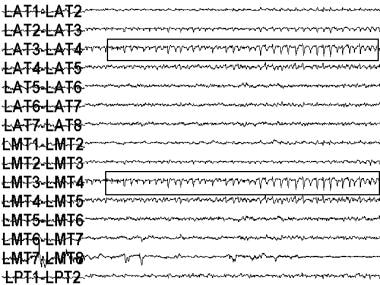 An electroencephalogram (EEG) recording of a seizu