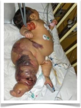 Newborn boy with Parks-Weber syndrome. Note severe