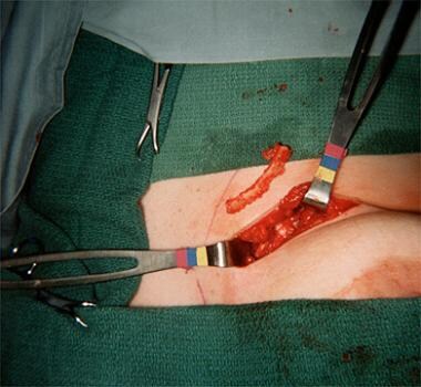 Rib cartilage graft and Proplast bridge graft. A 4