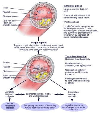 Coronary Artery Atherosclerosis. The illustrations