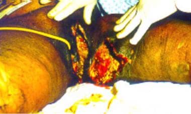 Sixty-year-old woman who had undergone postvaginal