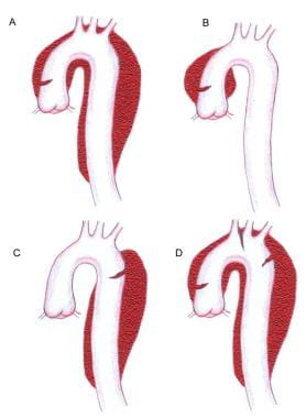 Image A represents a Stanford A or a DeBakey type 