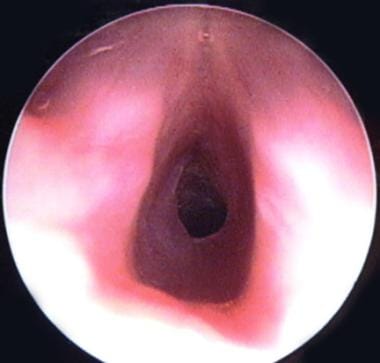 Postoperative view in a 4-month-old infant with ac