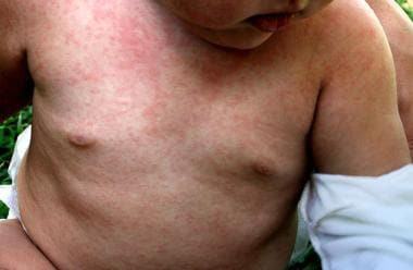 Roseola infantum. Image courtesy of Wikimedia Comm