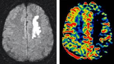 Magnetic resonance imaging in acute stroke. Diffus
