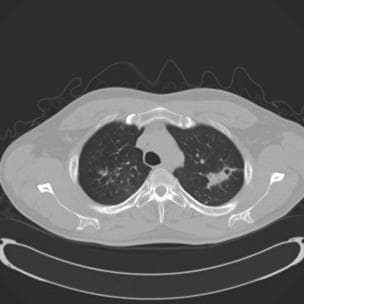 Coccidioidomycosis Imaging: Overview, Radiography, Ct Scan