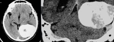 Transverse axial and coronal CT images show a larg