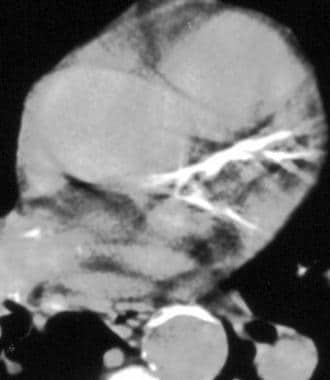 Helical non–contrast-enhanced CT reveals calcifica