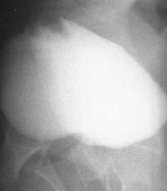 Crohn disease. Cystogram demonstrates a filling de
