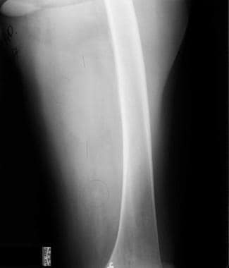 Radiograph demonstrates a soft tissue mass posteri