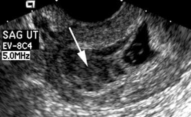 Duży krwotok podkosmówkowy jest obecny nad workiem ciążowym