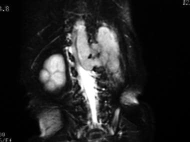 Coronal T2-weighted MRI in the same patient as in 