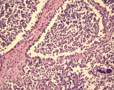 Alveolar rhabdomyosarcoma is evidenced by uniform 