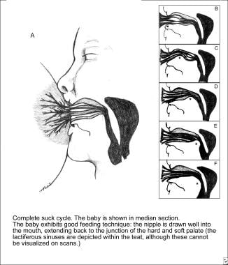 Counseling the Breastfeeding Mother. When breastfe