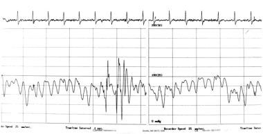Right atrial pressure waveform of a patient with c