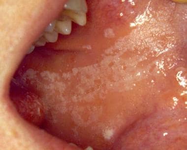 mucosa cheek oral hyperkeratosis biting frictional lesion rough area nibbling those habit clinical name typical roughened wider chewing presentation produced