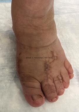 Clinical photograph showing correction of deformit