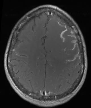 Axial contrast-enhanced MR shows prominent dural t