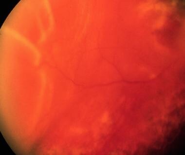 Retinal detachment due to peripheral tear in area 
