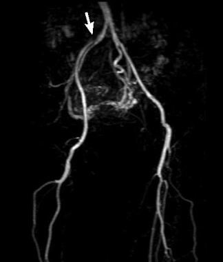 Aortitis. This image reveals moderate stenosis of