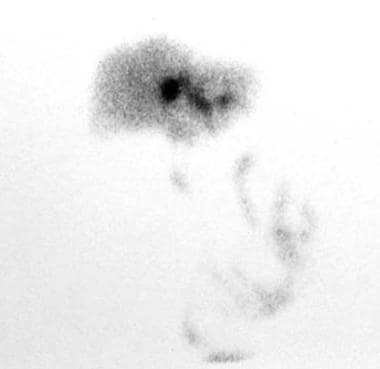 This technetium-99m iminodiacetic acid scan shows