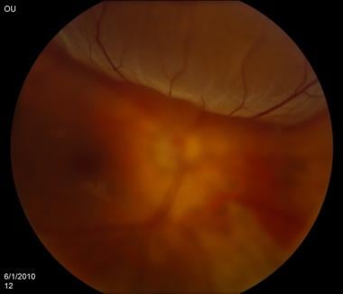 Retinal detachment. Courtesy of Kresge Eye Institu