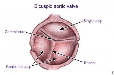 Bicuspid Aortic Valve. Bicuspid aortic valve with 