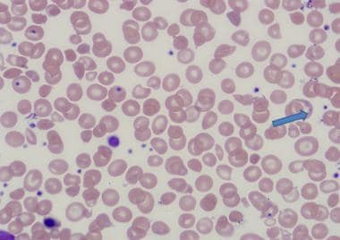 Basophilic stippling in thalassemia intermedia. 